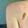 L’oncologo Ascierto: “Aumentano casi melanoma, lampade abbronzanti come fumo”